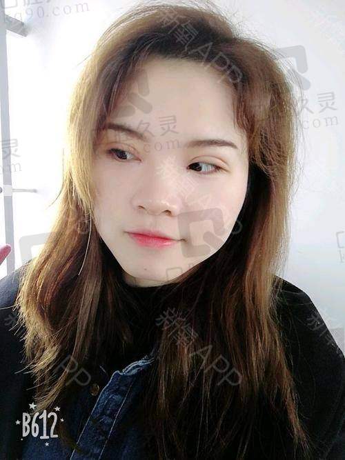 昆明韩辰整形美容医院切开双眼皮收费贵吗？肿眼泡小眼睛妹子靠它实现灵动大眼梦
