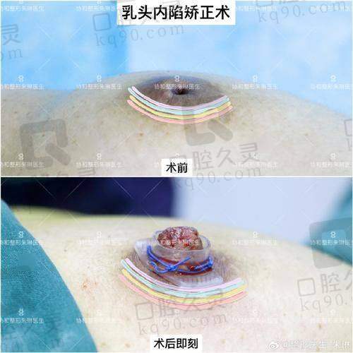 杭州维多利亚医疗美容医院有限公司刘中策做假体隆胸2025价格表分析