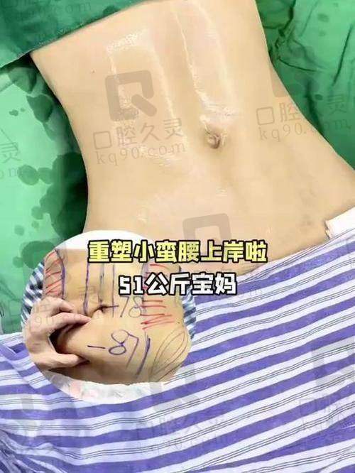 广州壹加壹整形美容医院吸脂瘦腹部医生排名公开！项美连等医生优势大揭秘