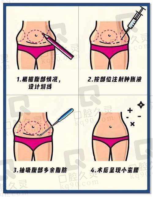 如何参考广州壹加壹整形美容医院吸脂瘦腹部医生排名选择医生？