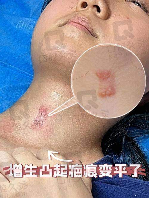 北京画美医疗美容医院不同祛疤项目价格是多少？