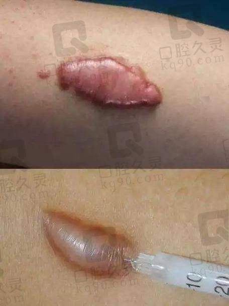 北京画美医疗美容医院祛疤修复价格多少钱？不同项目价格、性价比全揭秘！ 