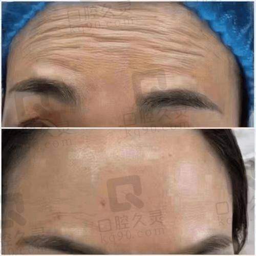 深圳艺星医疗美容医院玻尿酸除皱医生排名速看！邓璐雯、杨芳、汤洪波那个口碑好？