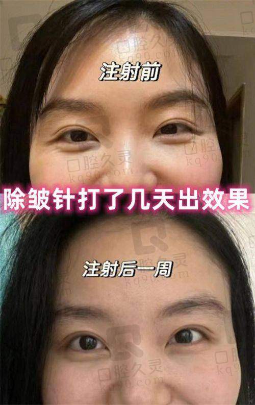 深圳艺星医疗美容医院玻尿酸除皱医生排名之景丽峰医生有什么优势？