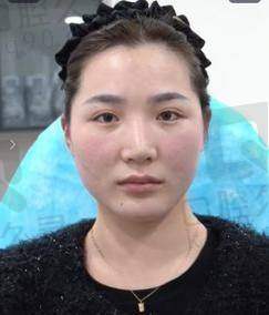 如何在深圳艺星医疗美容医院进行丰卧蚕？