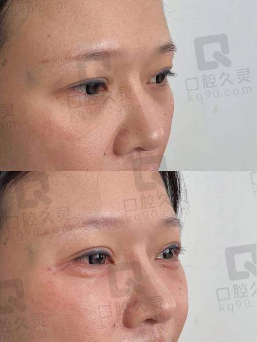 深圳艺星医疗美容医院丰卧蚕大概需要多少钱？受材料方式影响999 - 6000元 