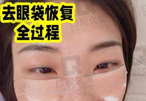 王太玲医生双眼皮眼袋价格