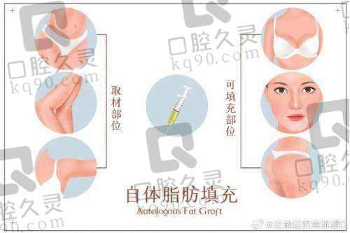 成都艾米丽脂肪填充怎么样？精湛技术、优质效果、贴心服务备受赞誉 