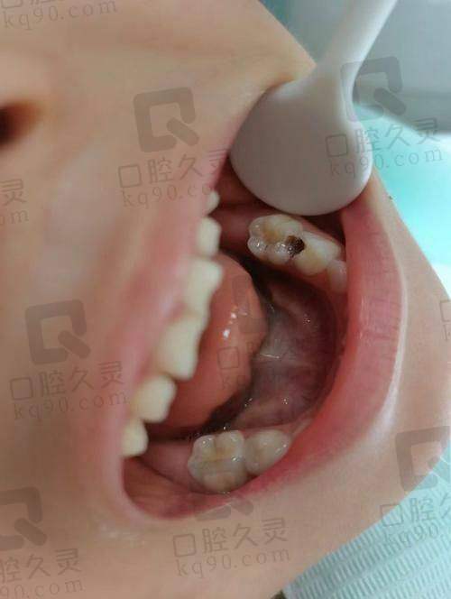 体验乌鲁木齐优佳贝口腔医院进口树脂补牙，坚固美观又耐用，牙齿问题轻松搞定 