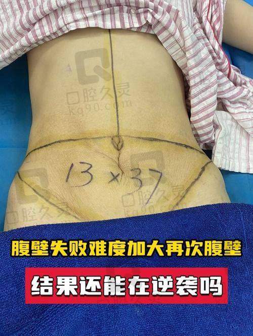 李献和腹壁成形价格明细公开透明，合理可控