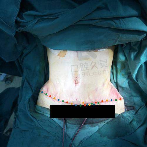 李献和腹壁成型怎么样？疤痕处理一绝，技术优势及口碑评价大曝光！