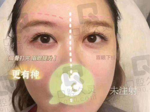 西安晶肤医美注射塑形轮廓体验：精准改善，轻松拥有精致立体好轮廓，超满意 
