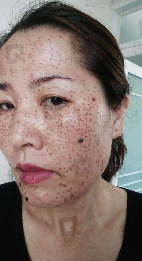 合肥维多利亚整形医院祛斑实例成效如何?