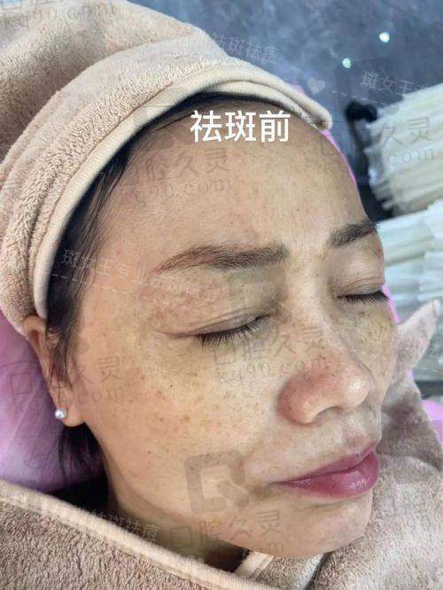 合肥维多利亚整形医院祛斑后会复发吗?