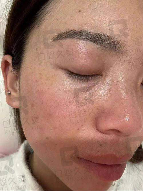 合肥维多利亚整形医院祛斑技术有哪些优势?
