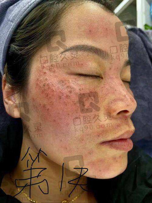 合肥维多利亚整形医院祛斑效果怎样？专业技术与优质服务，高效祛斑焕新颜 
