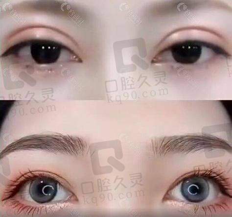 “东方灵韵桃花眼”是什么?黄军伟医生的创举术式风格