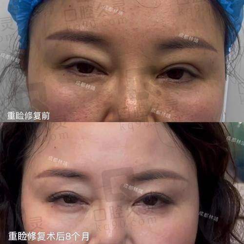 黄军伟医生会把双眼皮做得太窄吗?个性化设计避免模板化