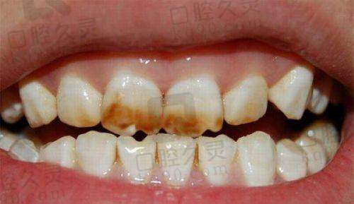 为什么中老年人都爱来这里种牙?