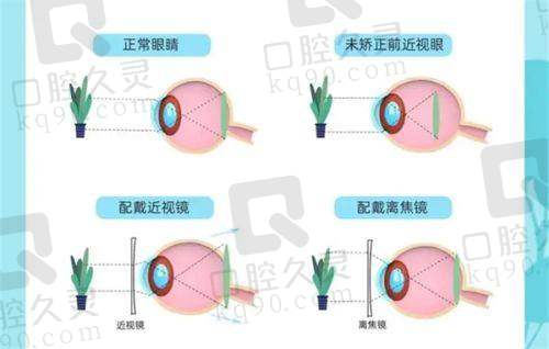 不同类型白内障手术价格差异
