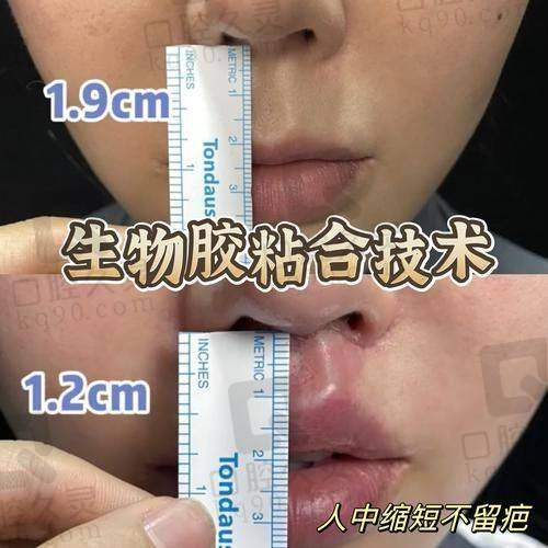 谭拯无痕人中缩短实例