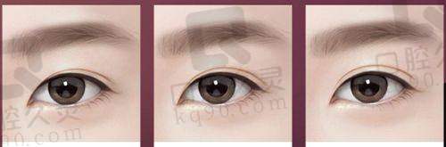 深圳瑞芙臣医疗美容双眼皮整形体验，自然灵动双眸轻松拥有，过程舒适效果超棒 