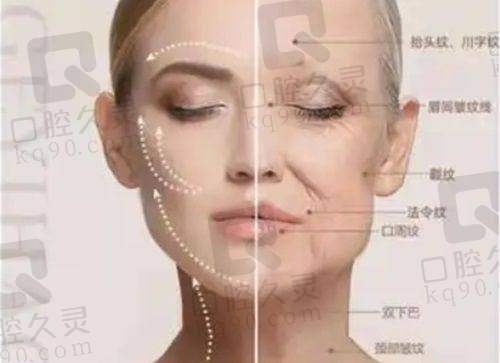 二、临汾佳美双矢量筋膜提升 1.0 手术:满足抗衰需求