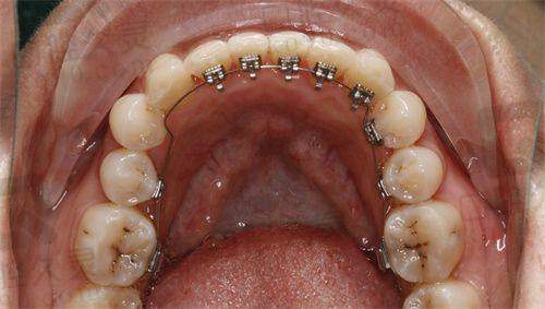 佩戴矫正器过程感受如何?