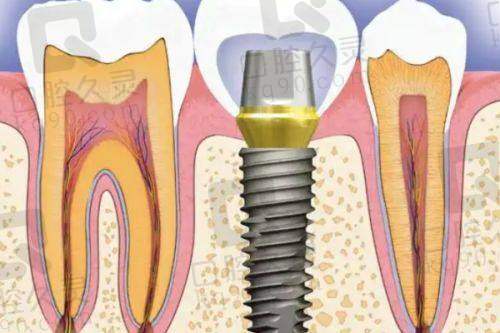 上海鼎植医生马列种植牙技术水平怎么样?