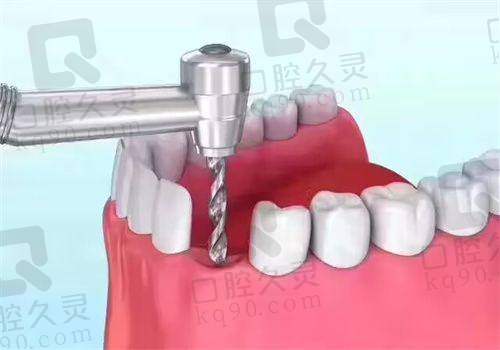 上海鼎植医生马列种植牙实例