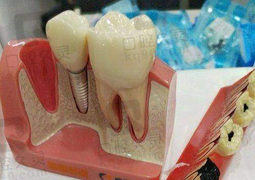 衢州蓝芽口腔医院种植牙技术有什么特色?