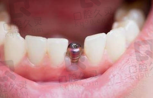 5、咸阳港派心语口腔吕振华医生患者评价: