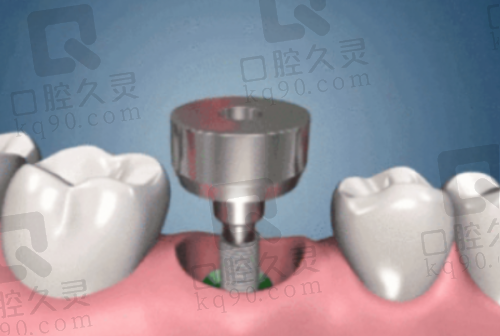 种植牙的过程痛苦吗?