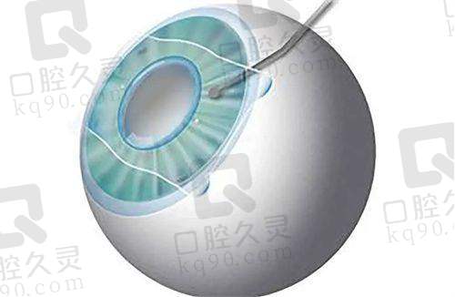 深圳爱尔眼科近视手术费用明细公开,不同术式费用差异及影响因素全知晓!