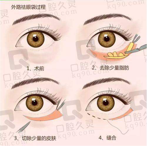 八大处王太玲双眼皮修复实例