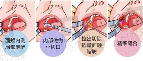 深圳瑞芙臣医疗美容双眼皮整形技术特色在哪里?