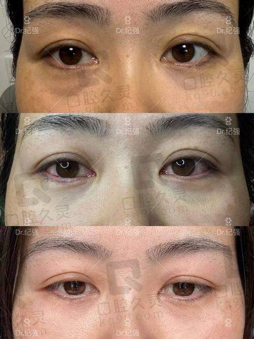 深圳瑞芙臣医疗美容的眼袋去除技术有哪些优势?