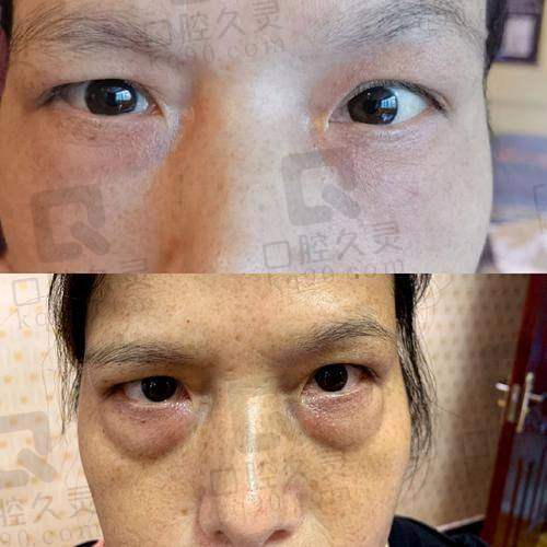 深圳瑞芙臣医疗美容做眼袋的术后成效能维持多久?