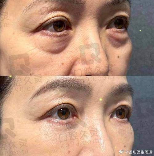 深圳瑞芙臣医疗美容的服务质量对眼袋去除成效有什么影响?