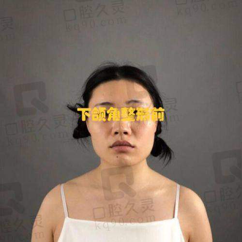 北京八大处做下颌角最好的医生是谁?靳小雷、滕利、张智勇技术精湛效果佳