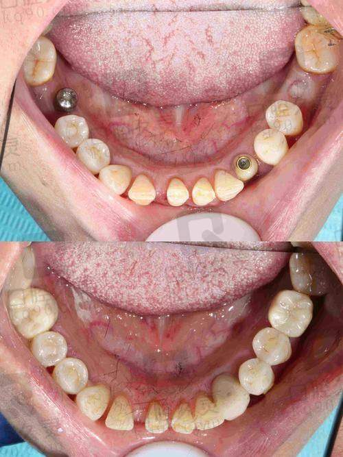 体验衢州蓝芽口腔医院种植牙，稳固耐用宛如真牙，咀嚼畅快生活品质提升 