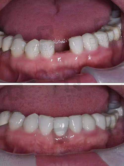 2、咸阳港派心语口腔吕振华医生种植牙怎么样?