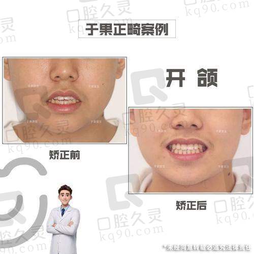 体验衢州蓝芽口腔医院牙齿矫正，收获整齐美牙，开启自信笑容新旅程！ 