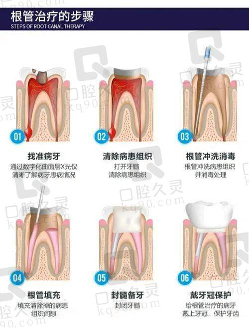 衢州蓝芽口腔医院牙齿根管治疗的成功实例有哪些?