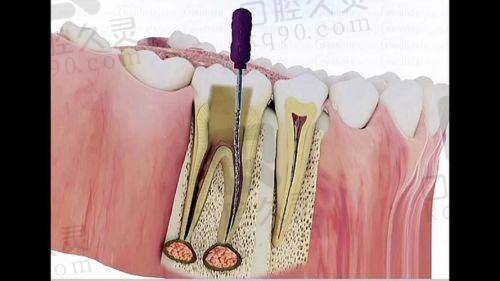 根管治疗的过程是怎样的?