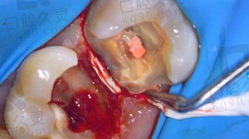 衢州蓝芽口腔医院牙齿根管治疗680元起,价格背后的秘密?