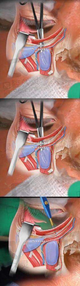 倪锋医生的面部提升术式一览:选术式看年纪和松弛程度