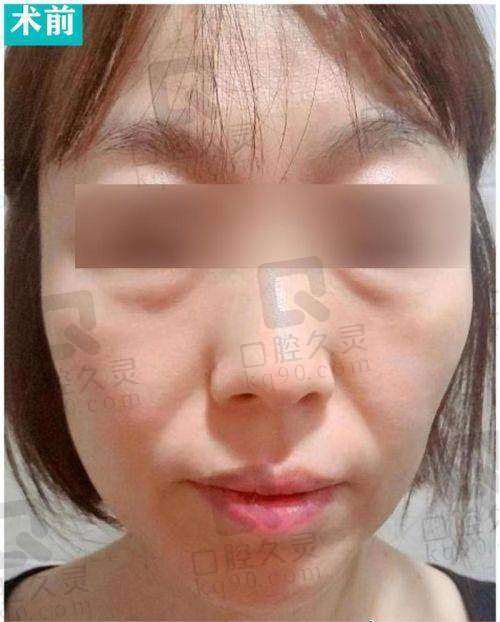 哪些人更适合面部拉皮?倪锋医生建议看3个指标