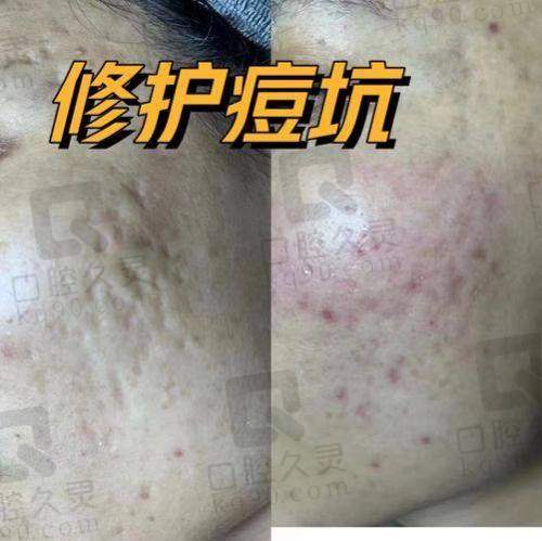 西宁韩美整形医院疤痕修复值得选择吗?
