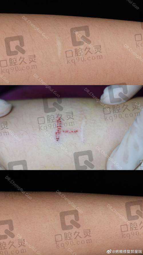 西宁韩美整形医院疤痕修复过程体验如何?